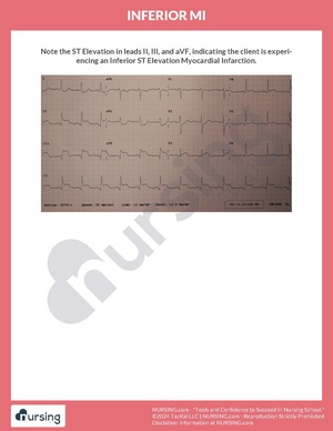 Inferior MI.pdf