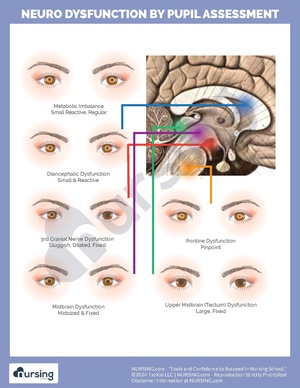 Pupil Changes by Location of Damage.pdf